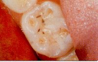 Fig. 13 These pothole-shaped lesions are caused by excessive occlusal load. 
