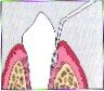 periodontal-disease-9